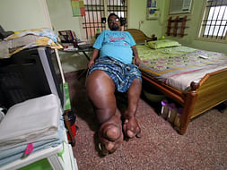 I live with a Rare Genetic Condition. You can help.