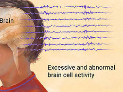 Help us Cure People with Epilepsy