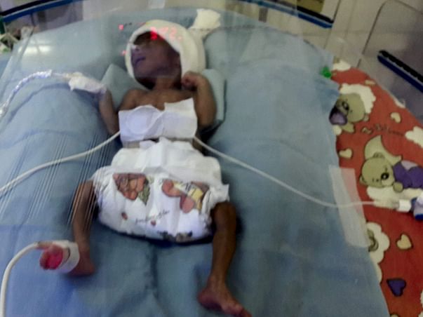 Help my premature Baby
