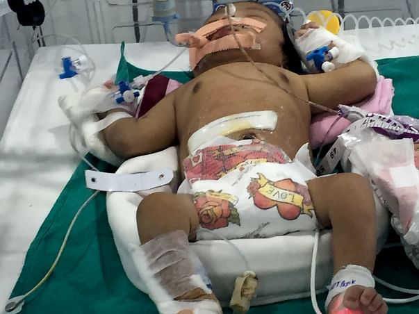 Help My Child to fight very rare disease Short Bowel Syndrome