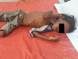 Save the lives of severely malnourished children in Bihar
