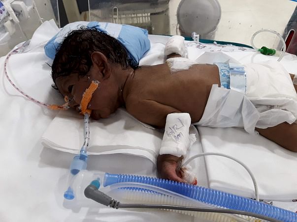 Help baby of Noorjahan undergo gastrostomy surgery