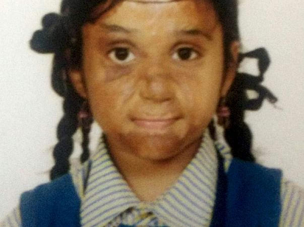 Madhupriya Needs Your Help To Recover From Severe Burns