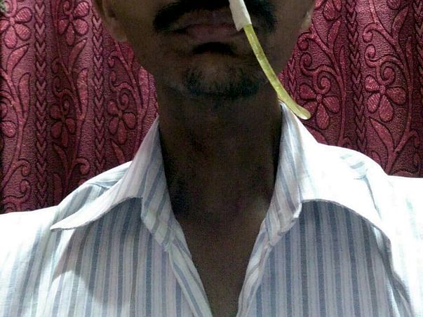 Chandrakant Rasal- Tongue Cancer