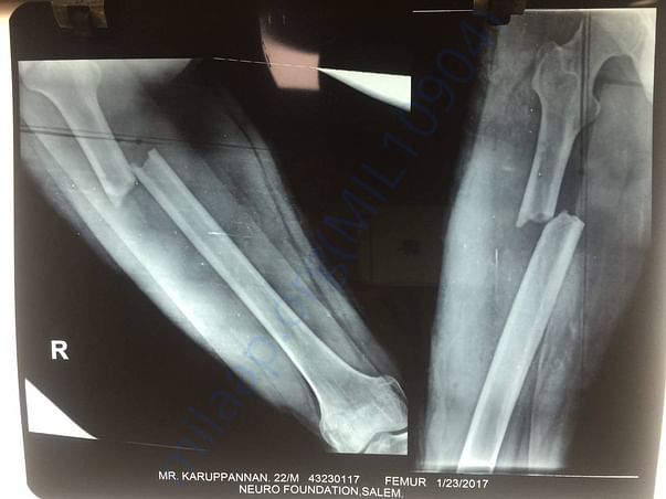 Femur bone x ray report