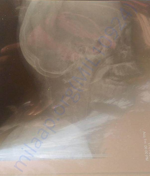 X ray1- uploaded by Himachali Blood Donors'