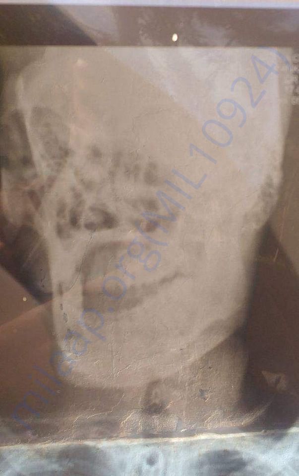 X ray2- uploaded by Himachali Blood Donors'