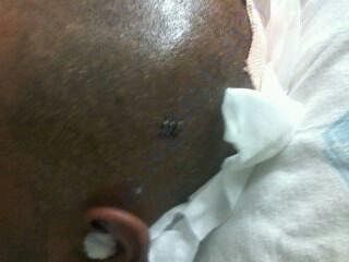 1st Surgery pic