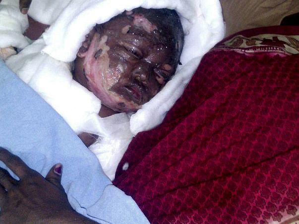 Help this 16 month old baby girl who is suffered serious burns.