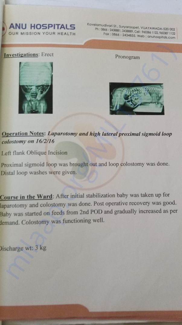 Colostomy operation(no asshole by birth) Details