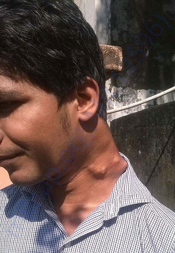 Rameez with his current growths in left neck