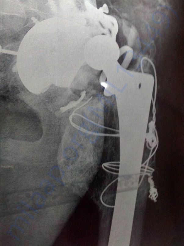 reconstructed acetabulum ( hip joint)