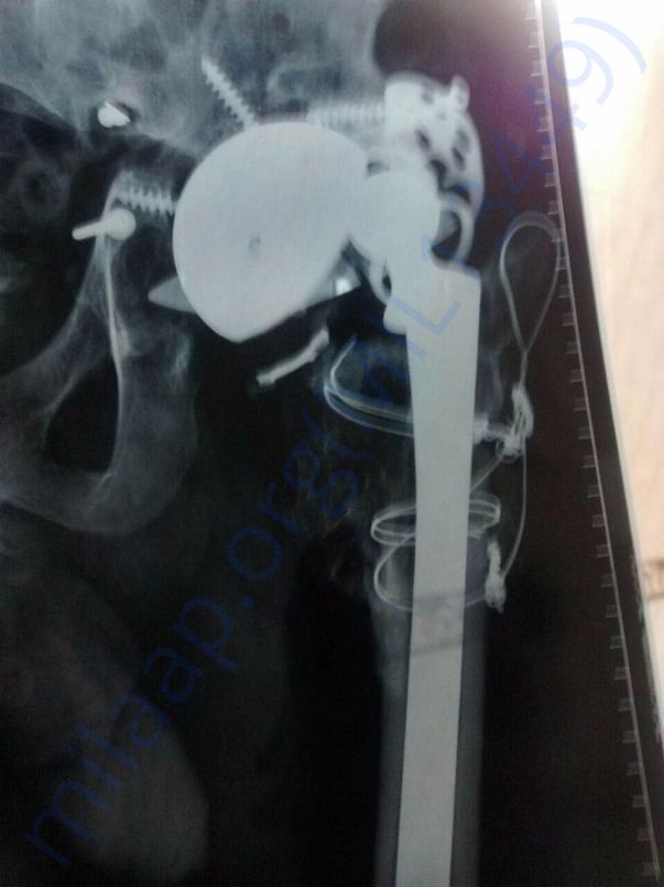 dislocated hip joint after 7th surgery (1)