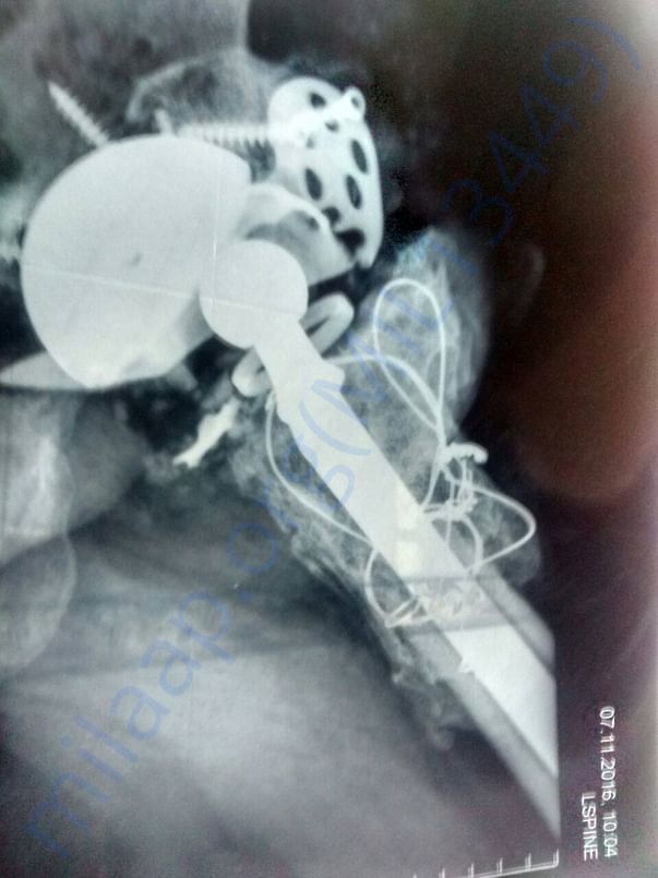 dislocated hip joint after 7th surgery (2)