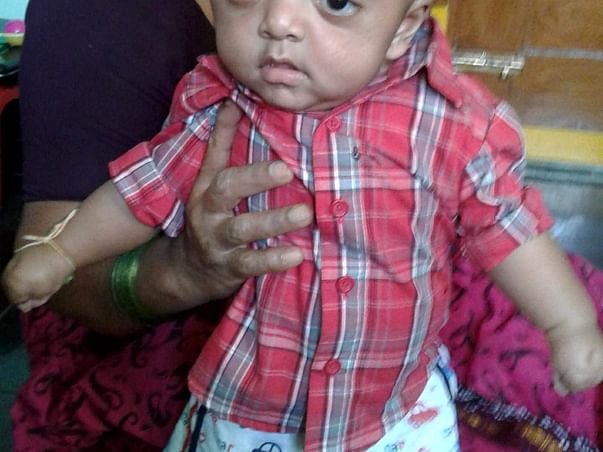 Help Vibhu Get Treated For Apert Syndrome
