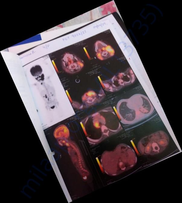 PET-Scan Report