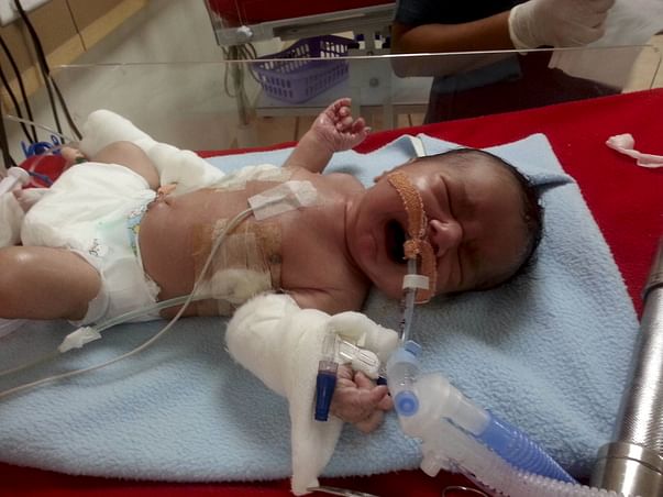 Help This Premature Baby Get Ventilator Support