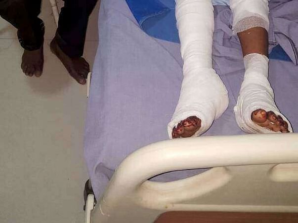 Help Poor Burn Victims from Jharkhand