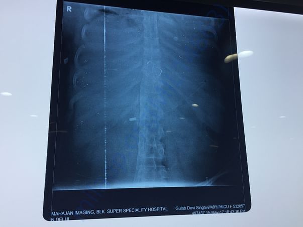 Chest X-Ray