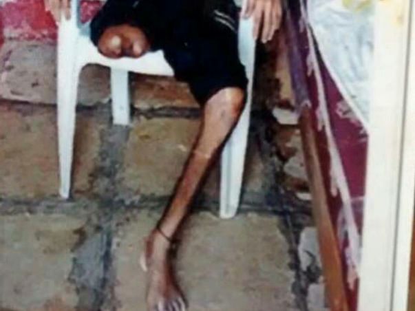 Help Mr Narasimha to fight back. He met with tragic accident lost limb