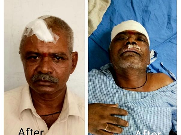 Help for Y Muthyallu double brain hemorrhage operation