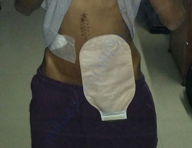 My stoma pouch