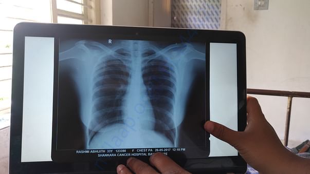 Chest XRay