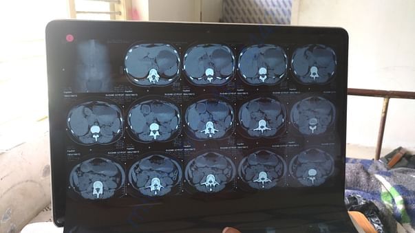 CT Scan
