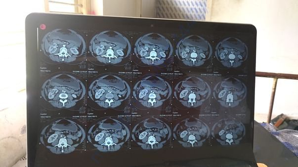 CT Scan