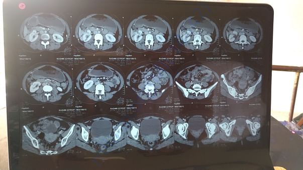 CT Scan