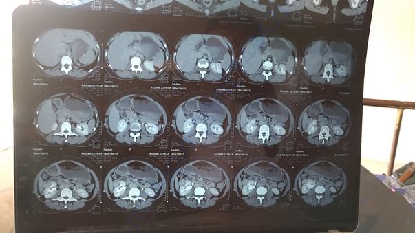 CT Scan
