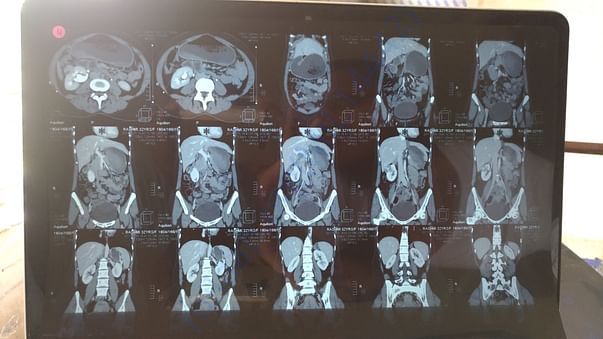 CT Scan