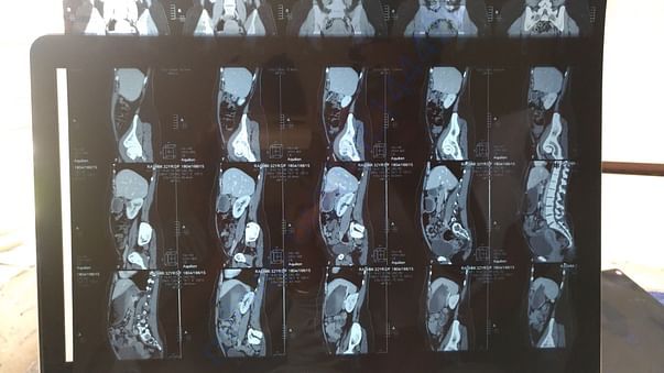 CT Scan