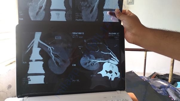 CT Scan
