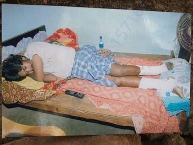 Satish's leg during the treatment a couple of years back -1