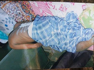 Satish's backbone during the treatment a couple of years back - 2