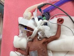 Help Baby of Sumedha Get Ventilator Support