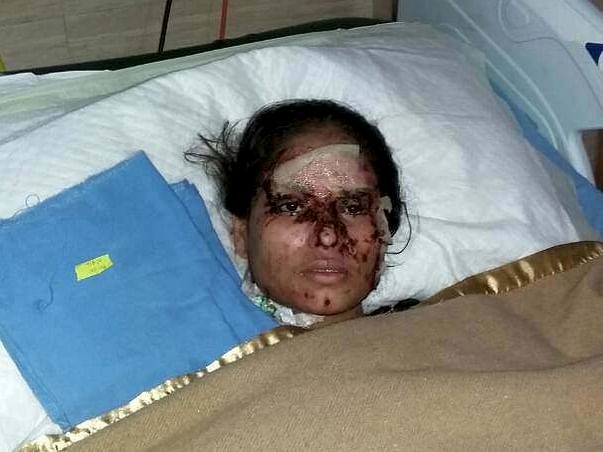 In Memory of Salma, Saving Relief Fund For Acute Acid Attack Cases