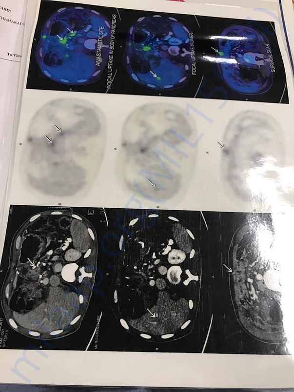 Cancer Report - Full body scan Report - 1
