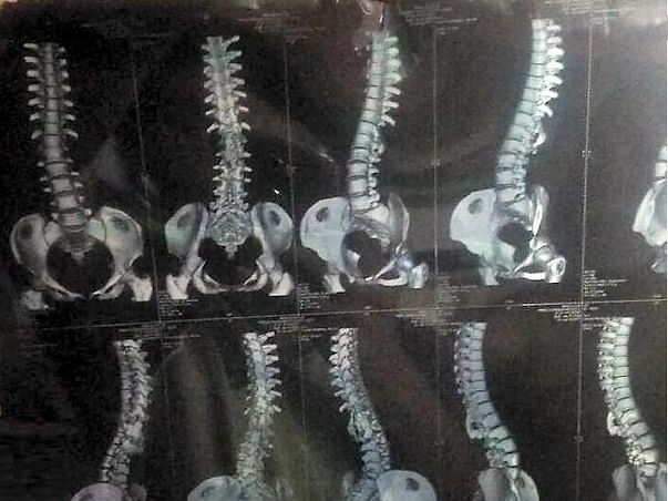 Help Manjula to undergo Backbone Surgery