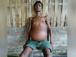 Man with beachball-sized belly is unable to sit or relieve himself