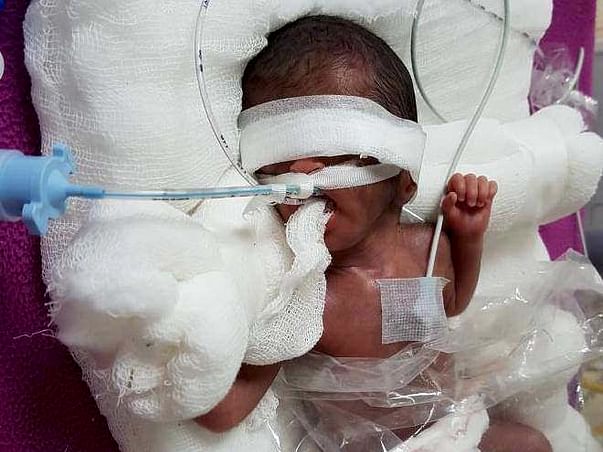 Extreme Premature Baby Fight Respiratory Distress