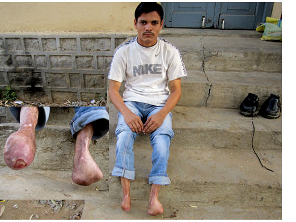 Help Feetless Yadagiri Buy Artificial Limbs