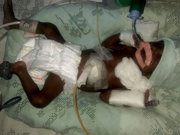 SAVE THIS PREMATURE BABY