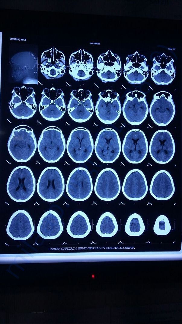 CTA BRAIN -2