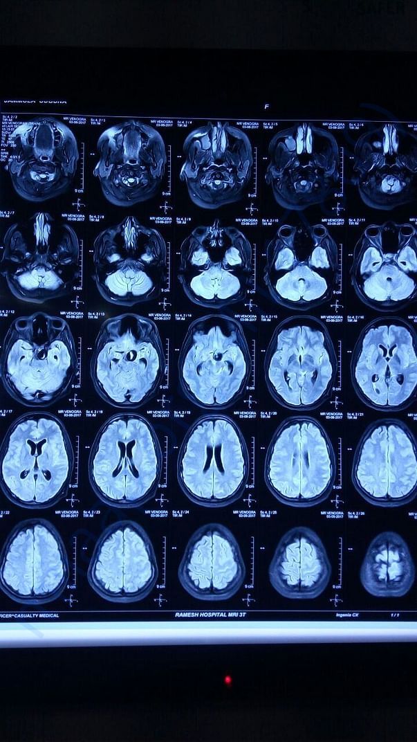 MRI Brain -2