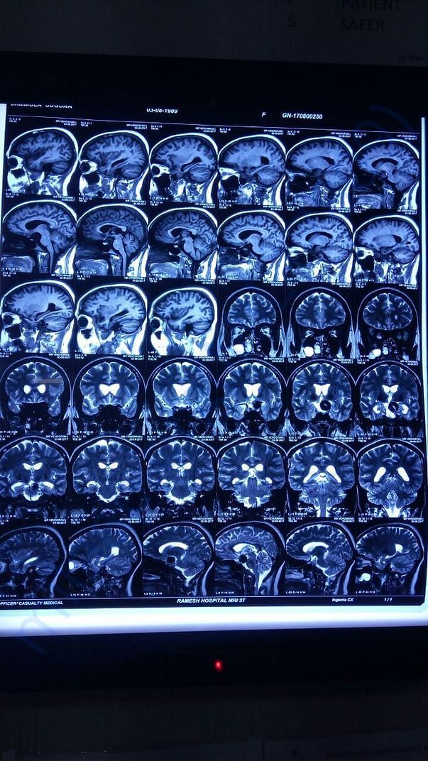 MRI Brain -4