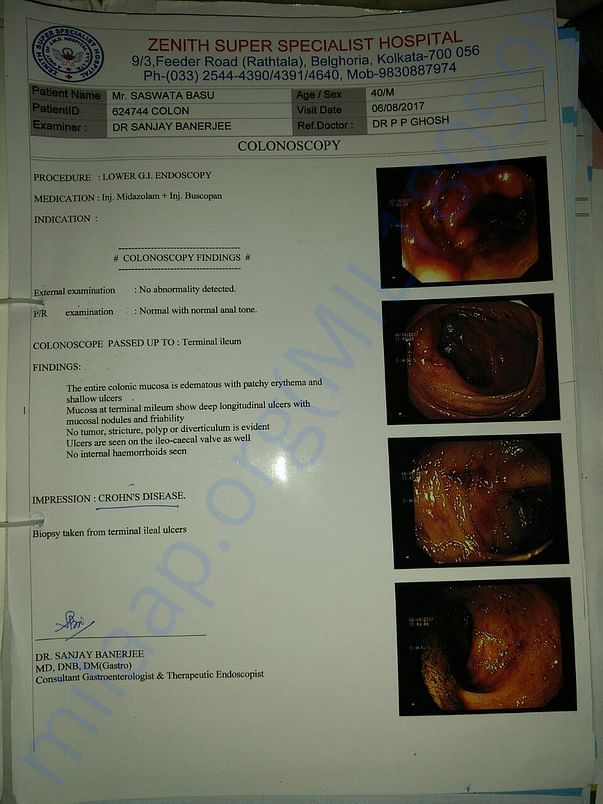 Colonoscopy report indicating CROHN'S DISEASE
