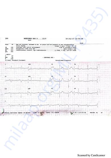 ECG