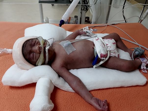 Fisherman Who Lost One Twin Before Birth Needs Help To Save The Other
